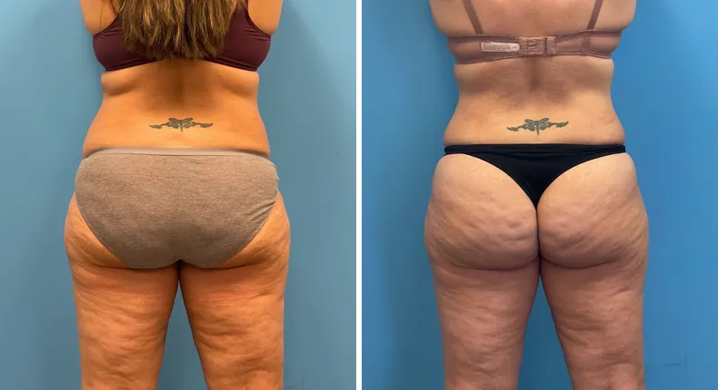 Before and after tummy tuck: patient's abdomen from the back, with liposuction