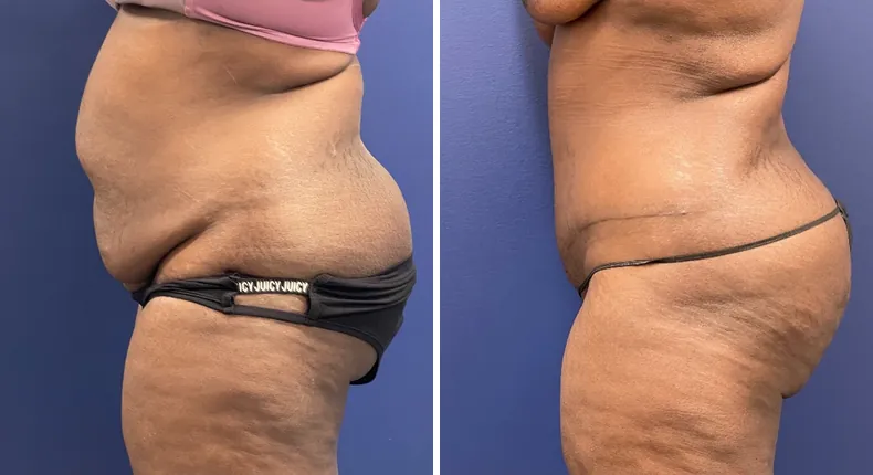 Before and after tummy tuck: patient's abdomen from the left side, with liposuction