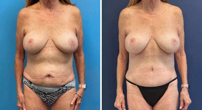 Before and after tummy tuck: patient's abdomen from the front, with liposuction
