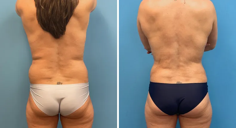 Before and after tummy tuck: patient's abdomen from the back, with body lift, breast augmentation with lift and liposuction