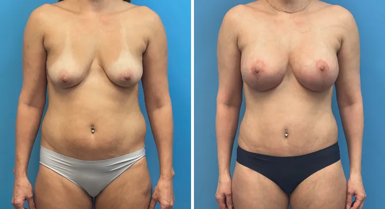 Before and after tummy tuck: patient's abdomen from the front, with body lift, breast augmentation with lift and liposuction