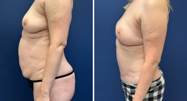 Before and after tummy tuck: woman's abdomen from the left side, with liposuction and breast reconstruction