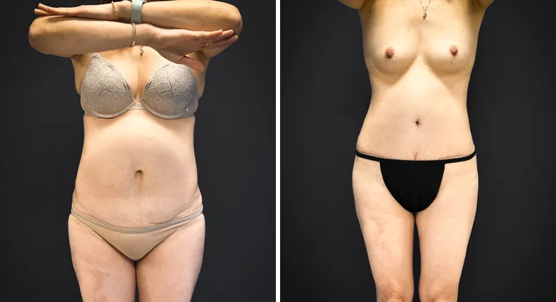Before and after tummy tuck: patient's abdomen from the front