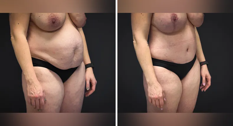 Before and after tummy tuck: patient's abdomen from the left side, with liposuction