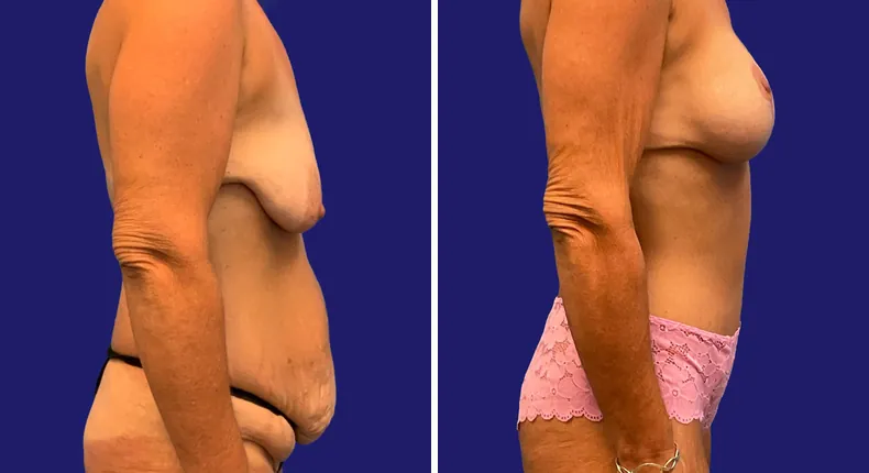 Before and after tummy tuck: woman's abdomen, with breast augmentation, breast lift, liposuction, mommy makeover and arm lift