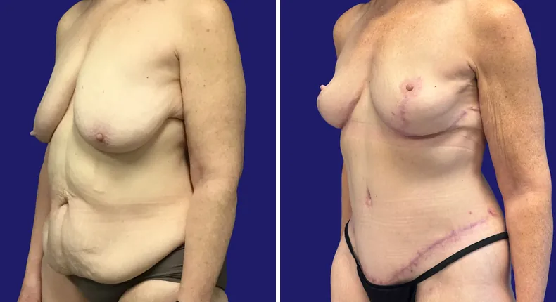 Before and after tummy tuck: woman's abdomen, with liposuction and mommy makeover