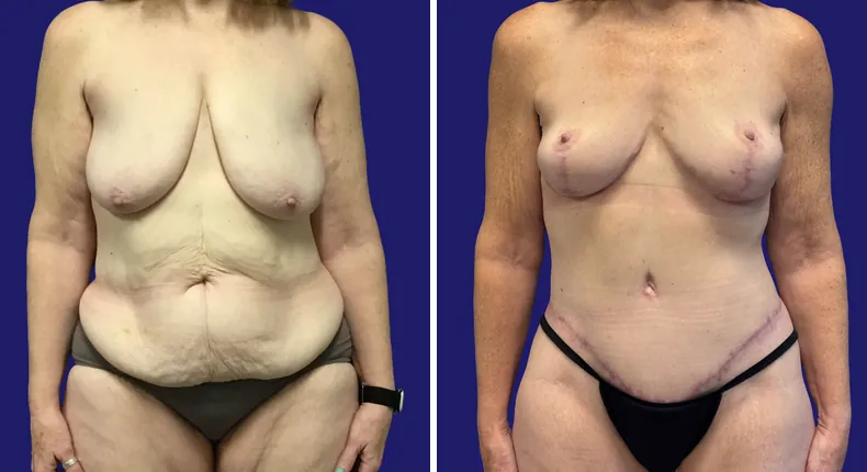 Before and after tummy tuck: woman's abdomen, with liposuction and mommy makeover