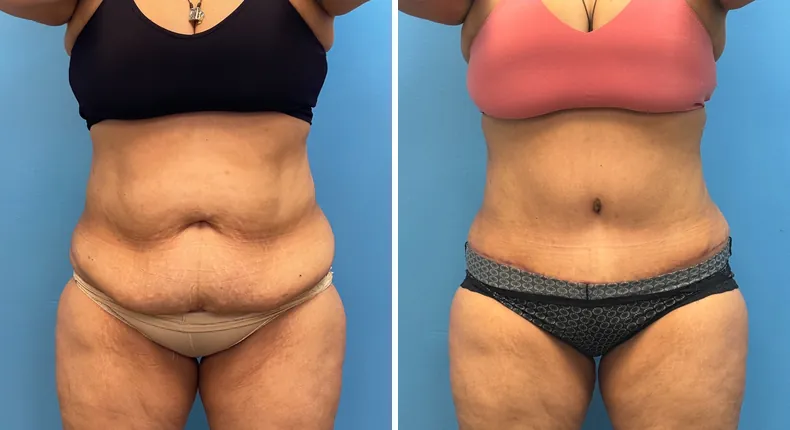 Before and after tummy tuck: patient's abdomen from the front, with liposuction