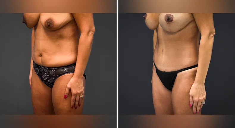 Before and after tummy tuck: patient's abdomen from the left side, with liposuction