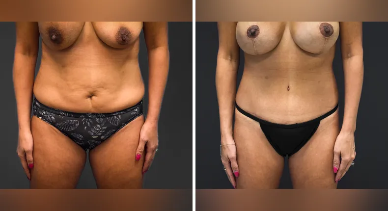 Before and after tummy tuck: patient's abdomen from the front, with liposuction