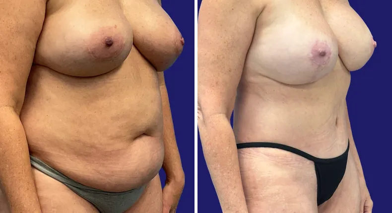 Before and after tummy tuck: woman's abdomen, with breast reconstruction, breast augmentation with lift and liposuction