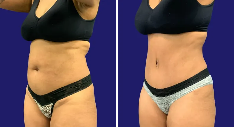 Before and after tummy tuck: woman's abdomen, with liposuction