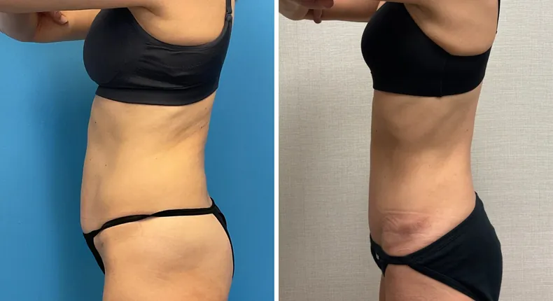 Before and after tummy tuck: patient's abdomen from the left side