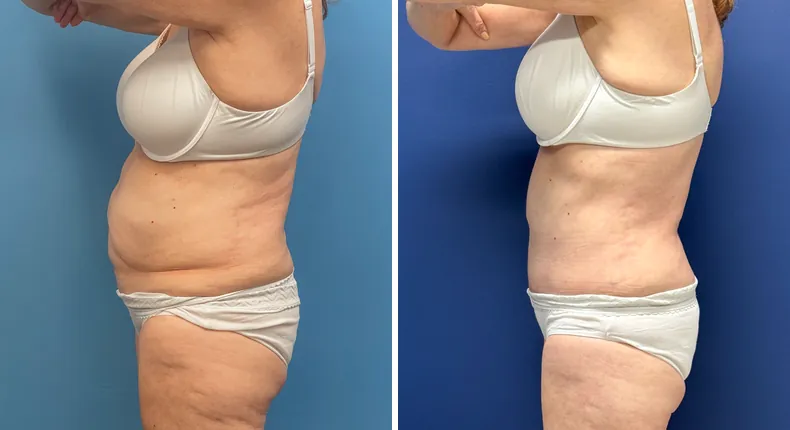 Before and after tummy tuck: patient's abdomen from the left side, with liposuction