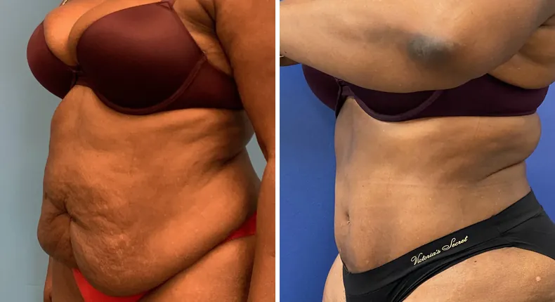 Before and after tummy tuck: patient's abdomen at a left angle