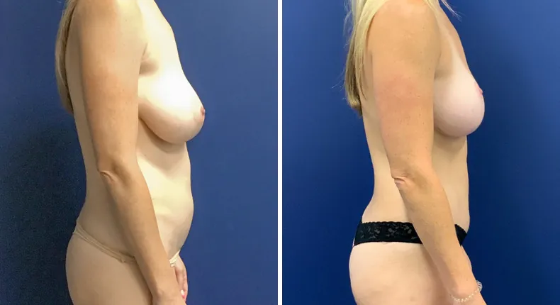 Before and after tummy tuck: patient's abdomen from the right side, with revision breast augmentation
