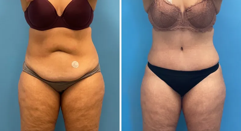 Before and after tummy tuck: patient's abdomen from the front, with liposuction