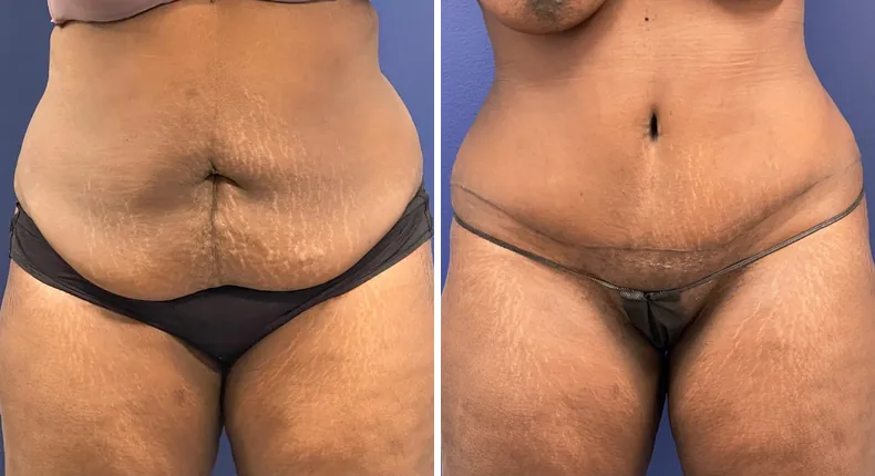 Before and after tummy tuck: patient's abdomen from the front, with liposuction