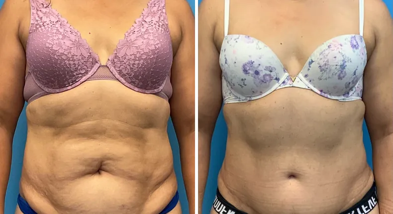 Before and after tummy tuck: patient's abdomen from the front