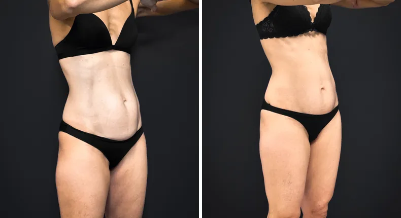 Before and after tummy tuck: patient's abdomen from the right side