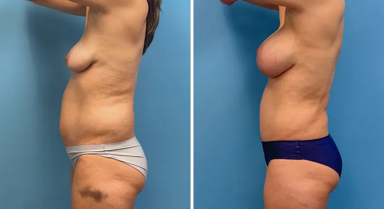 Before and after tummy tuck: patient's abdomen from the left side, with body lift, breast augmentation with lift and liposuction