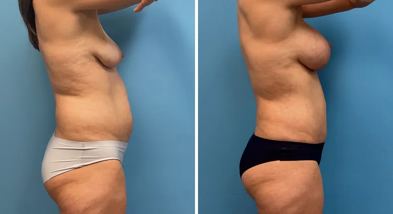 Before and after tummy tuck: patient's abdomen from the right side, with body lift, breast augmentation with lift and liposuction