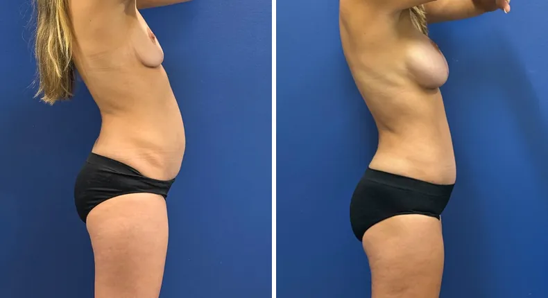 Before and after tummy tuck: patient's abdomen from the right side, with breast augmentation with lift and liposuction