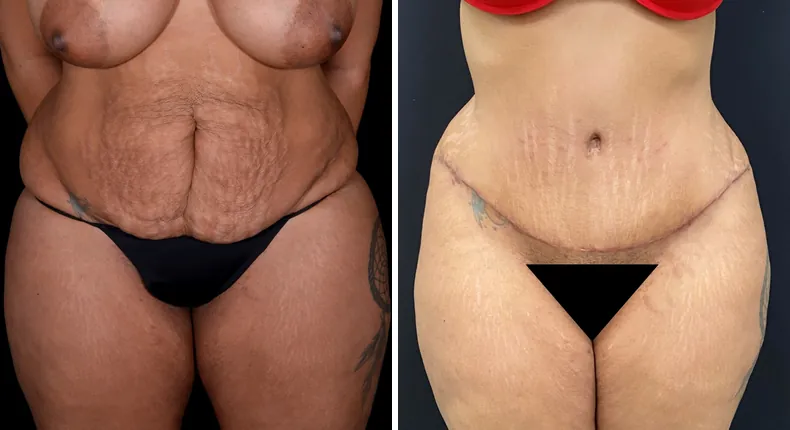 Before and after tummy tuck: woman's abdomen from the front, with liposuction