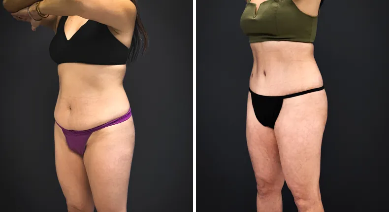Before and after tummy tuck: patient's abdomen from the left side