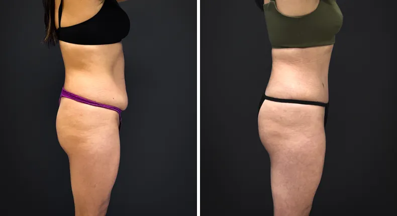Before and after tummy tuck: patient's abdomen from the right side