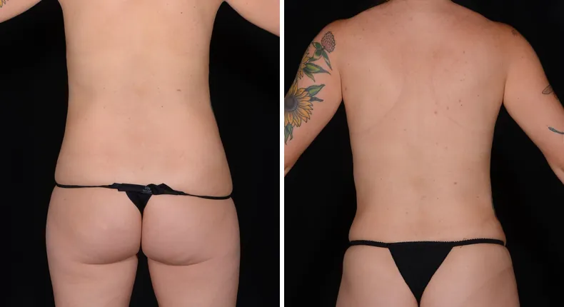Before and after tummy tuck: patient's abdomen from the back