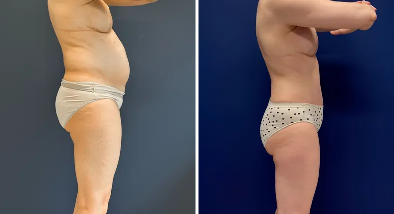 Before and after tummy tuck: patient's abdomen