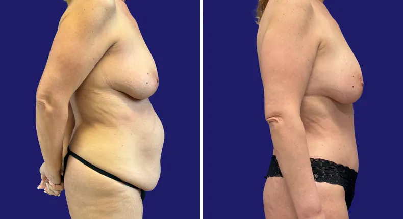 Before and after tummy tuck: woman's abdomen, with liposuction