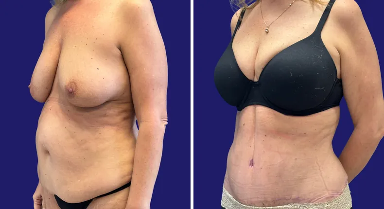 Before and after tummy tuck: woman's abdomen, with liposuction