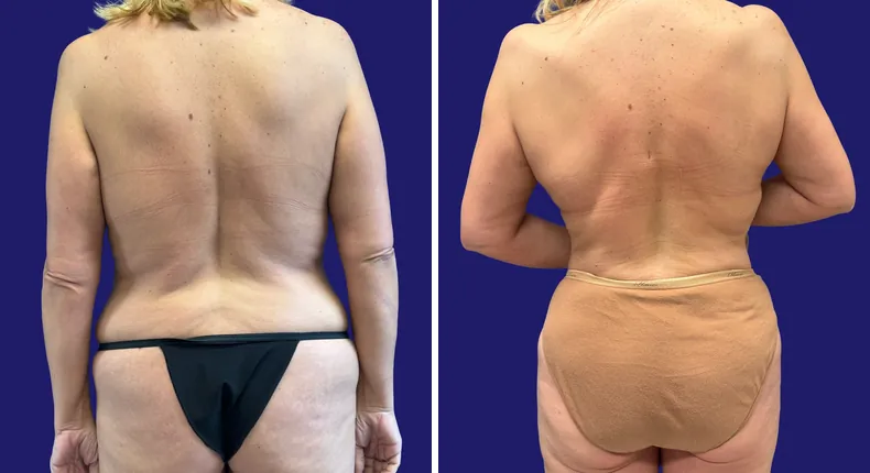Before and after tummy tuck: woman's abdomen, with liposuction