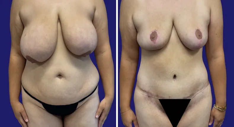 Before and after tummy tuck: woman's abdomen from the front, with breast lift, breast reduction, liposuction and mommy makeover