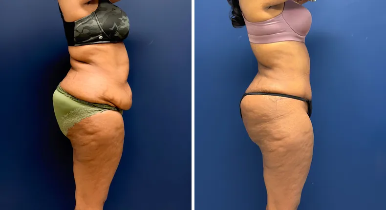 Before and after tummy tuck: patient's abdomen, with liposuction