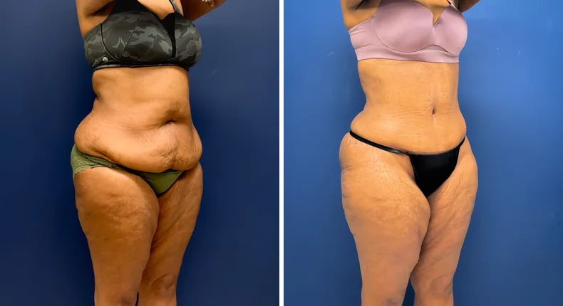 Before and after tummy tuck: patient's abdomen, with liposuction