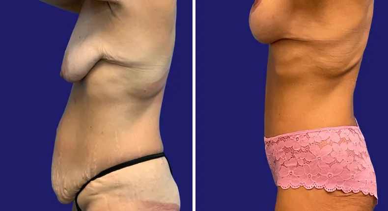 Before and after tummy tuck: woman's abdomen, with breast augmentation, breast lift, liposuction, mommy makeover and arm lift
