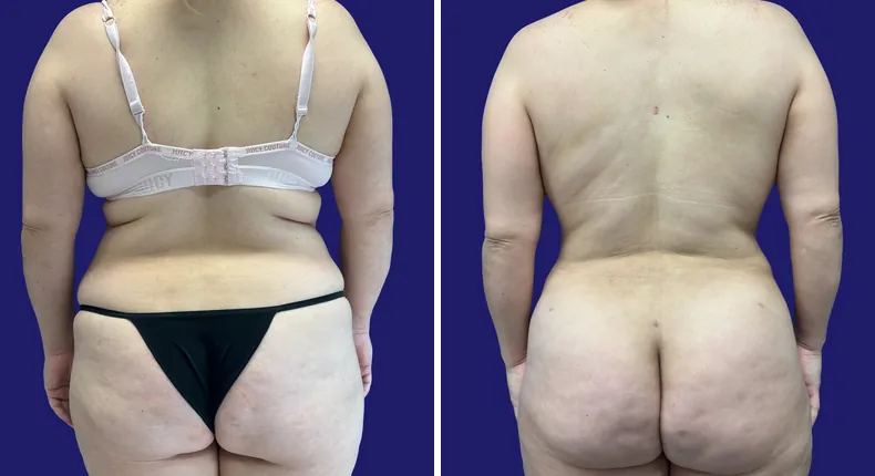 Before and after tummy tuck: woman's abdomen, with liposuction, mommy makeover and brazilian butt lift (bbl)