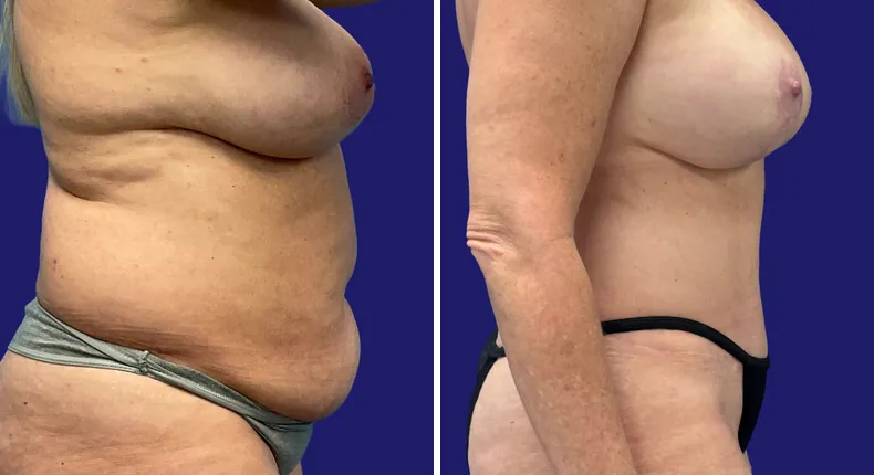 Before and after tummy tuck: woman's abdomen, with breast reconstruction, breast augmentation with lift and liposuction