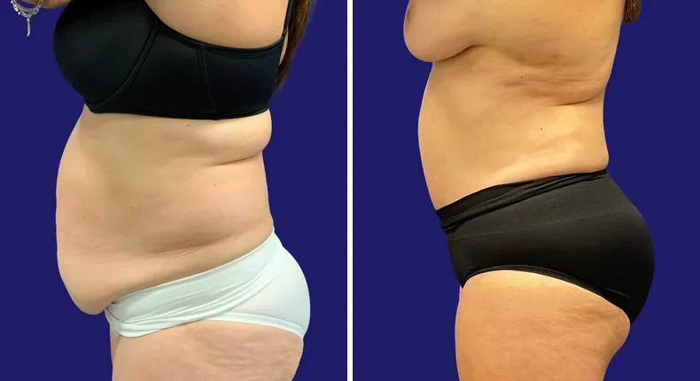 Before and after tummy tuck: woman's abdomen