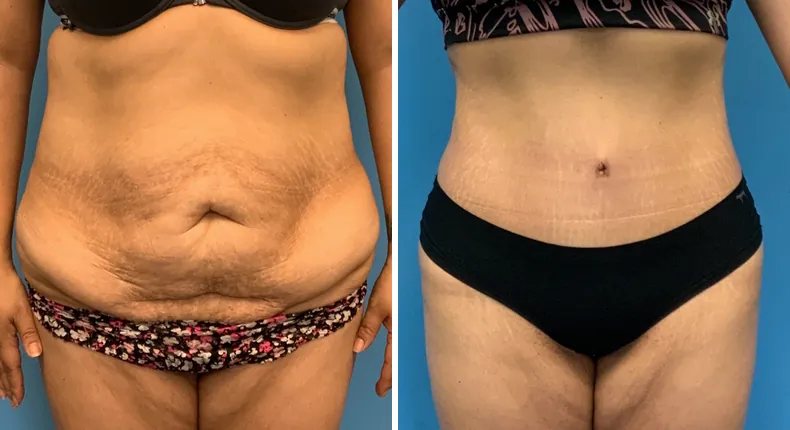 Before and after tummy tuck: patient's abdomen from the front