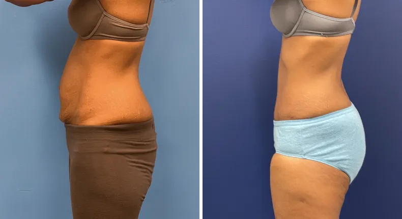 Before and after tummy tuck: patient's abdomen from the left side, with liposuction