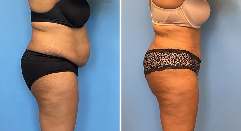 Before and after tummy tuck: patient's abdomen from the left side, with liposuction