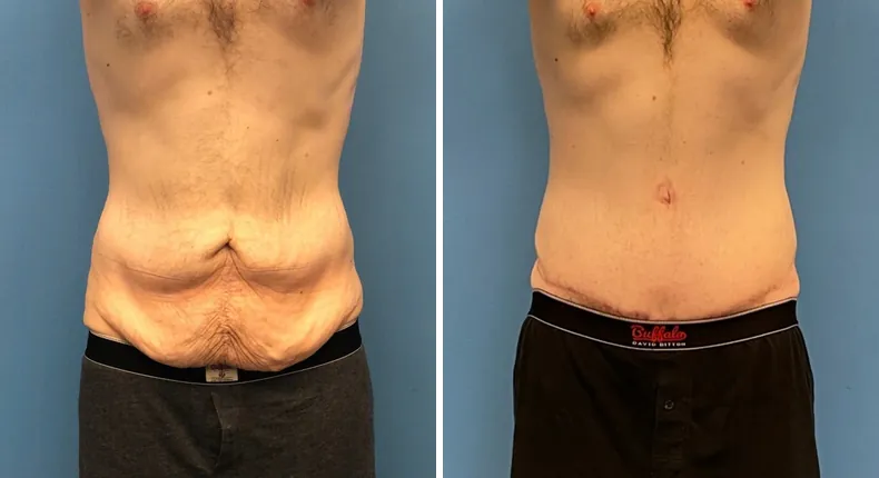Before and after tummy tuck: patient's abdomen from the front, with body lift