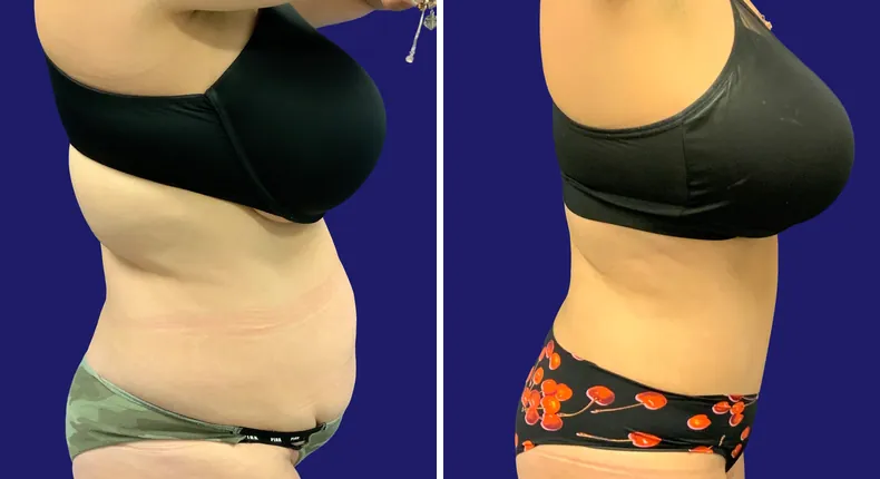 Before and after tummy tuck: woman's abdomen, with breast lift, breast reduction and mommy makeover