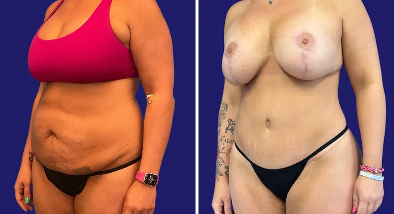 Before and after tummy tuck: woman's abdomen, with breast augmentation, breast lift, liposuction and mommy makeover