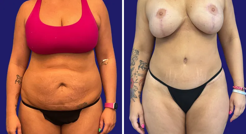 Before and after tummy tuck: woman's abdomen, with breast augmentation, breast lift, liposuction and mommy makeover