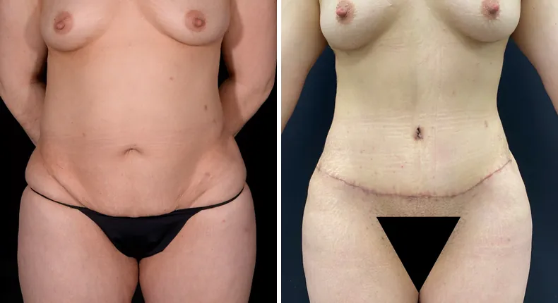 Before and after tummy tuck: patient's abdomen from the front, with liposuction